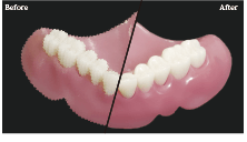 デンチャーでは自然な光沢で厚みを抑える